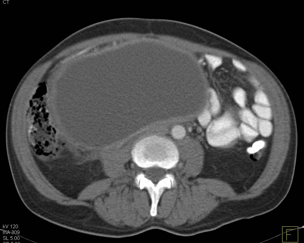 Large Pancreatic Pseudocyst - CTisus CT Scan