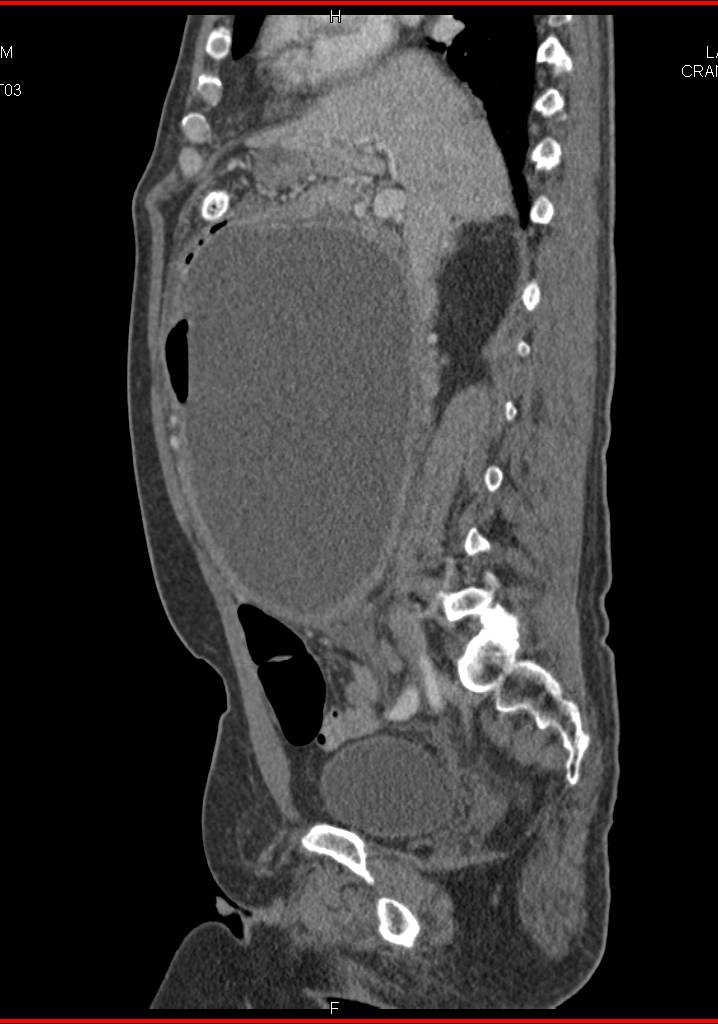 Large Pancreatic Pseudocyst - CTisus CT Scan