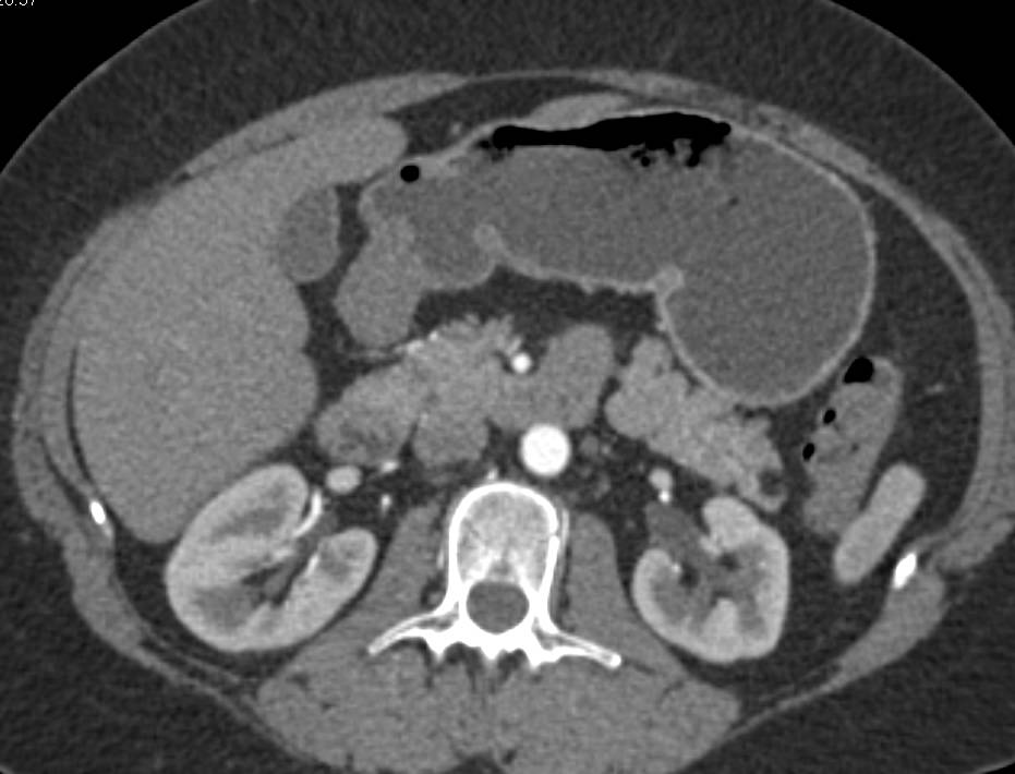 Lipoma in Tail of Pancreas - CTisus CT Scan