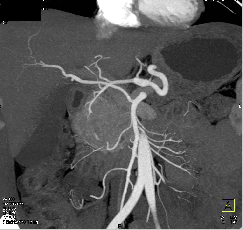 Neuroendocrine Tumor in the Head of the Pancreas - CTisus CT Scan