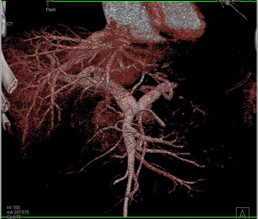 Neuroendocrine Tumor in Head of the Pancreas - CTisus CT Scan