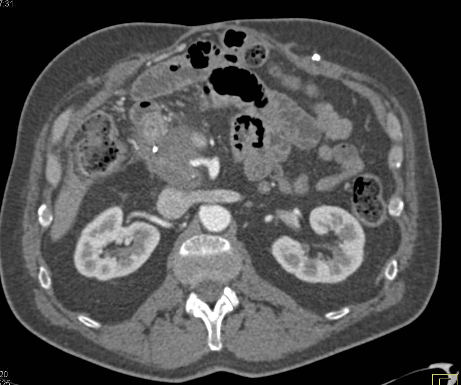 Pancreatic Adenocarcinoma Encases Arterial and Venous Structures - CTisus CT Scan