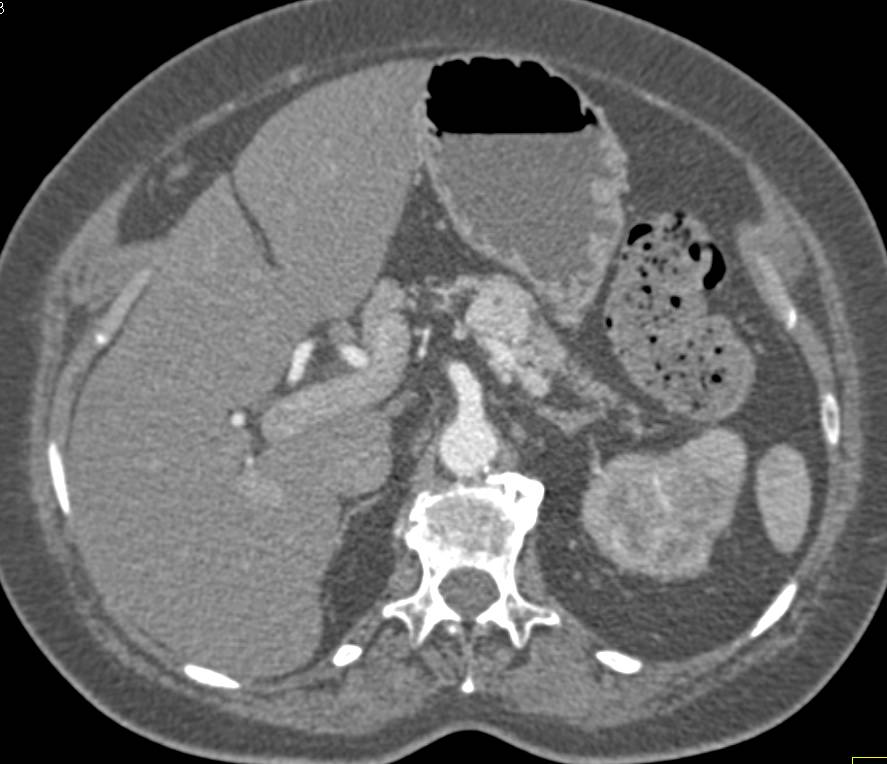 Metastatic Renal Cell Carcinoma to the Pancreas and Contralateral Kidney with Vascular Metastases - CTisus CT Scan