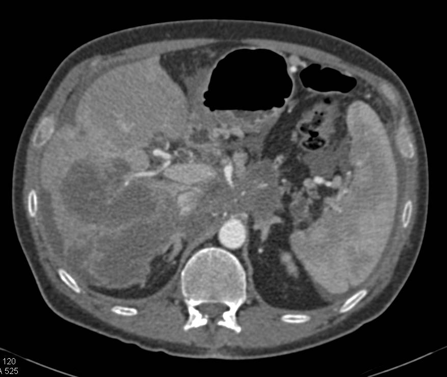 Pancreatic Adenocarcinoma with Carcinomatosis - CTisus CT Scan