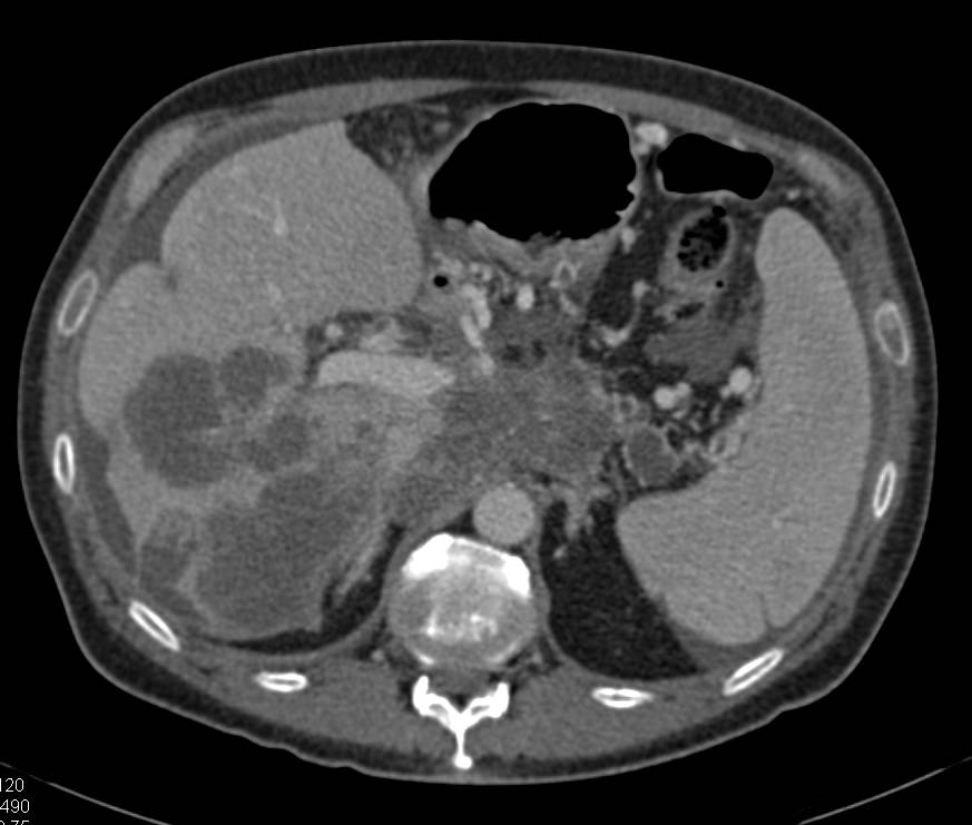 Pancreatic Adenocarcinoma Encases the Celiac and Hepatic Artery with Liver Metastases and Carcinomatosis - CTisus CT Scan