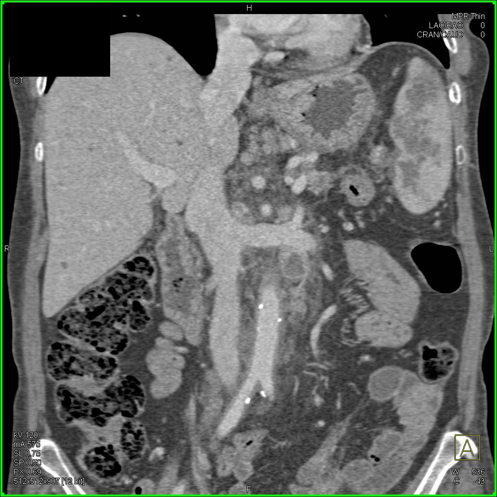 Unusual Case of Pancreatic Adenocarcinoma with Splenic Metastases and Cystic Adenopathy - CTisus CT Scan