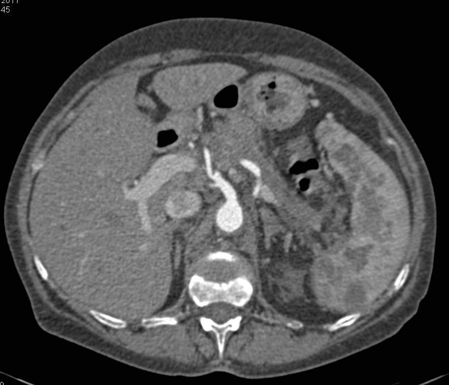 Pancreatc Adenocarcinoma with Splenic Metastases - CTisus CT Scan