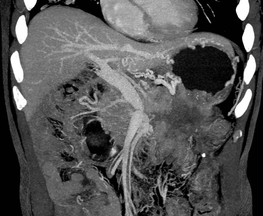 Pancreatic Cancer Encases the PV/SMV/SV Complex and Occludes the Splenic Vein - CTisus CT Scan