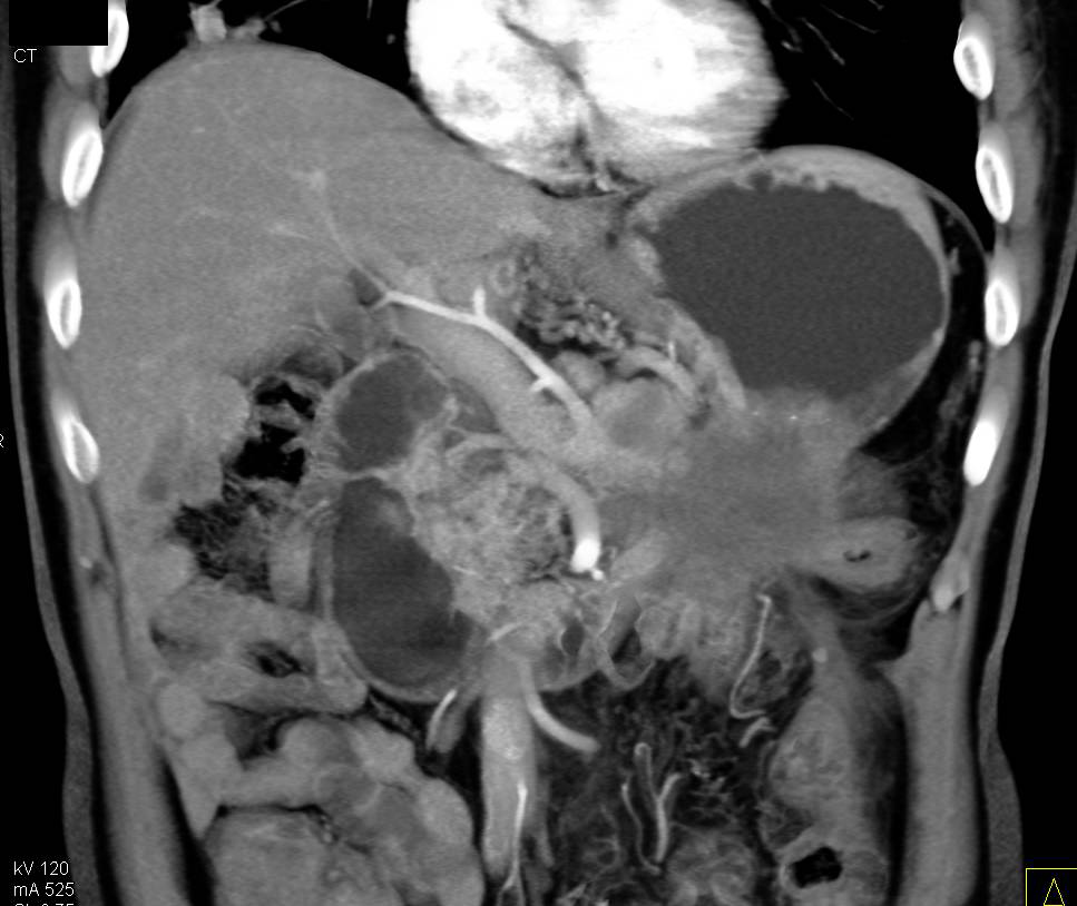 Infiltrating Carcinoma of the Tail of the Pancreas with Carcinomatosis - CTisus CT Scan