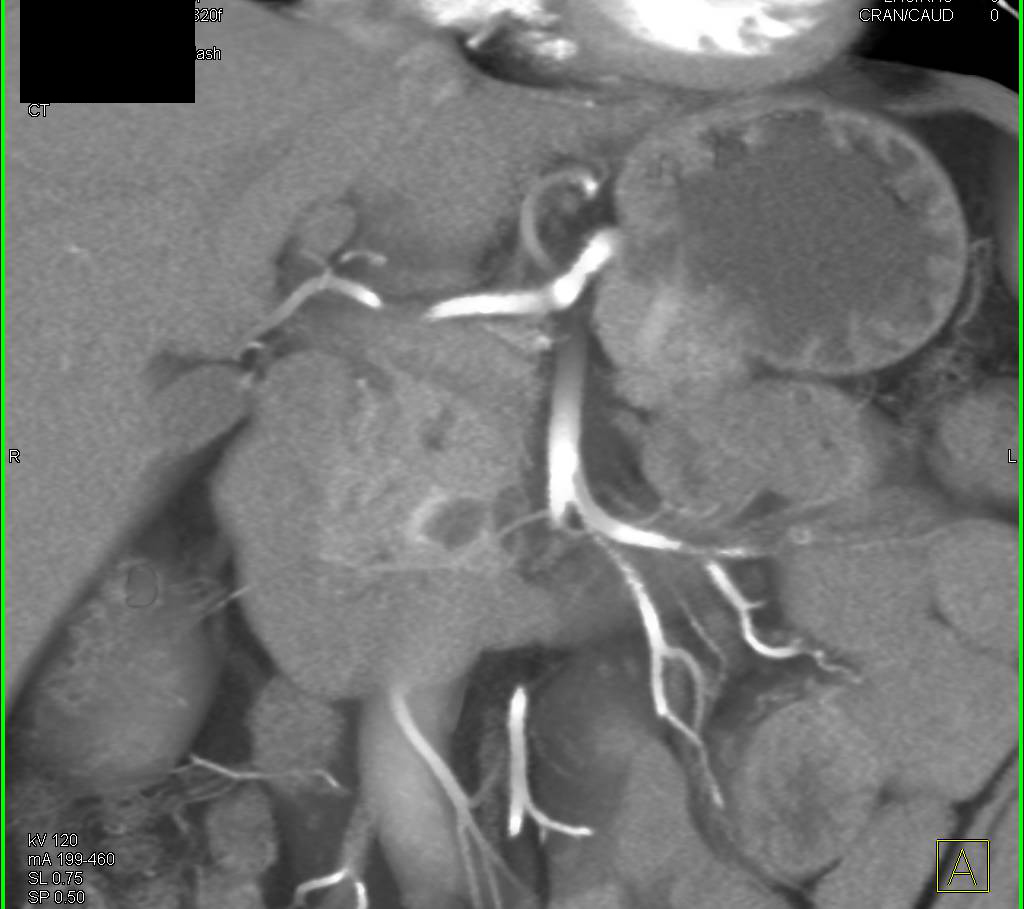 Cystic Neuroendocrine Tumor in the Head of the Pancreas - CTisus CT Scan