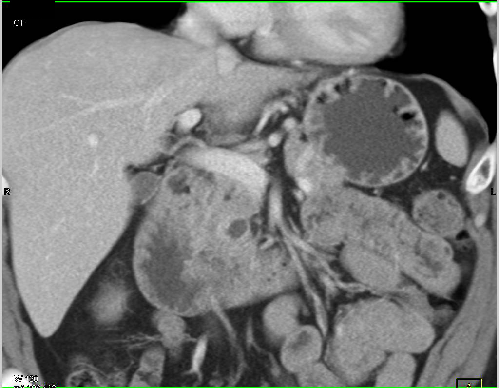 Cystic Neuroendocrine Tumor in the Head of the Pancreas - CTisus CT Scan