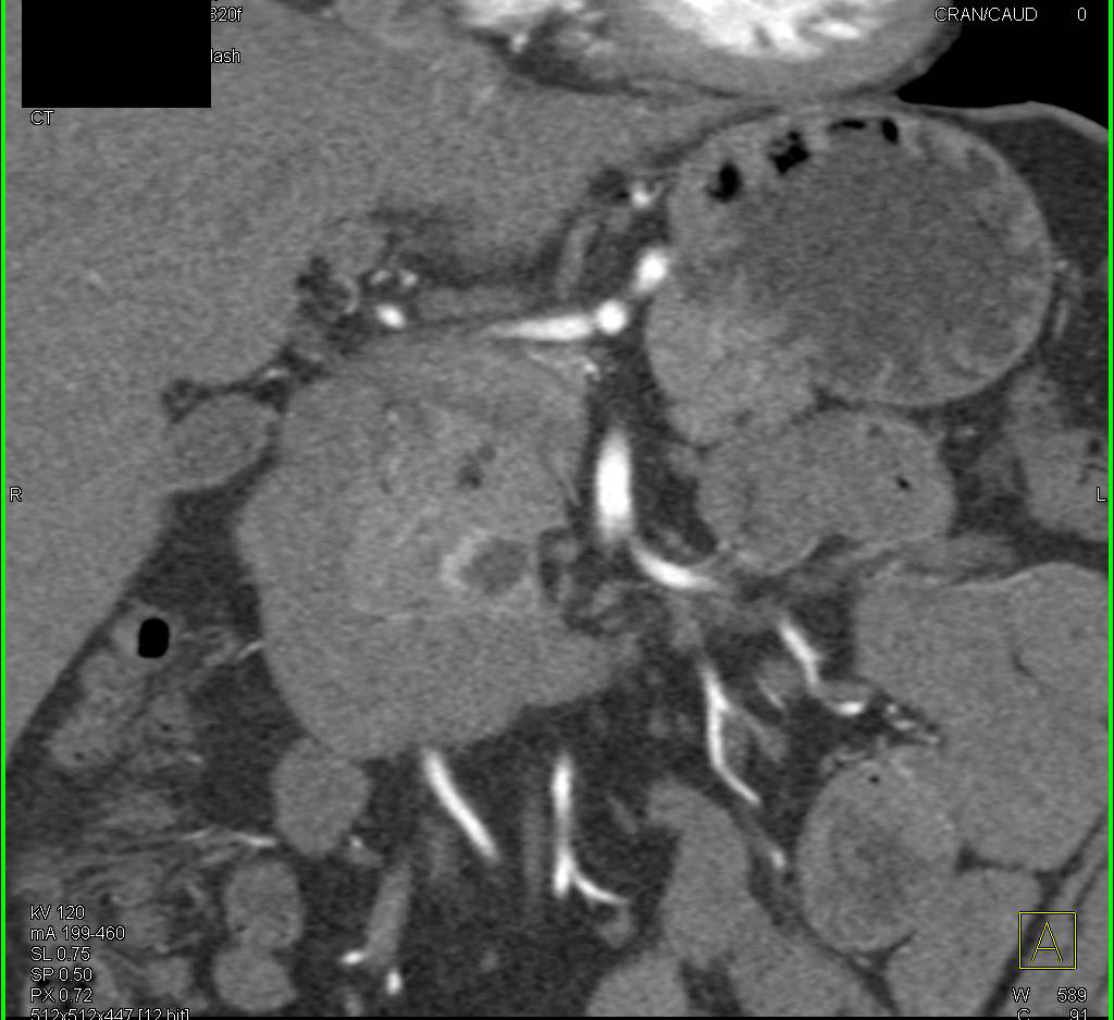 Small Cystic Neuroendocrine Tumor of the Pancreas - CTisus CT Scan