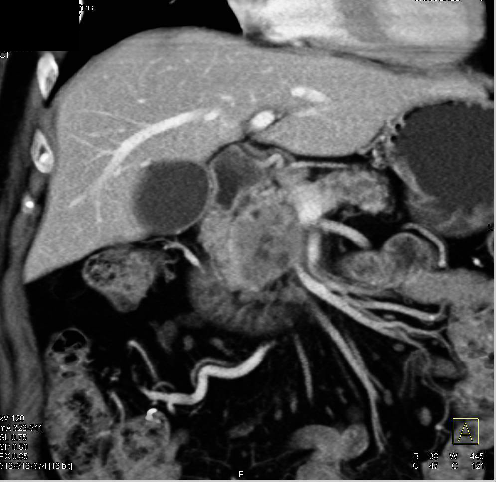 Pancreatic Adenocarcinoma - CTisus CT Scan