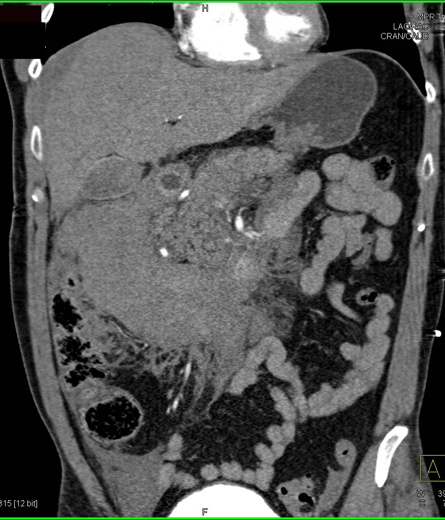 Hematoma Near Pancreas and Right Pararenal Space due to Trauma - CTisus CT Scan
