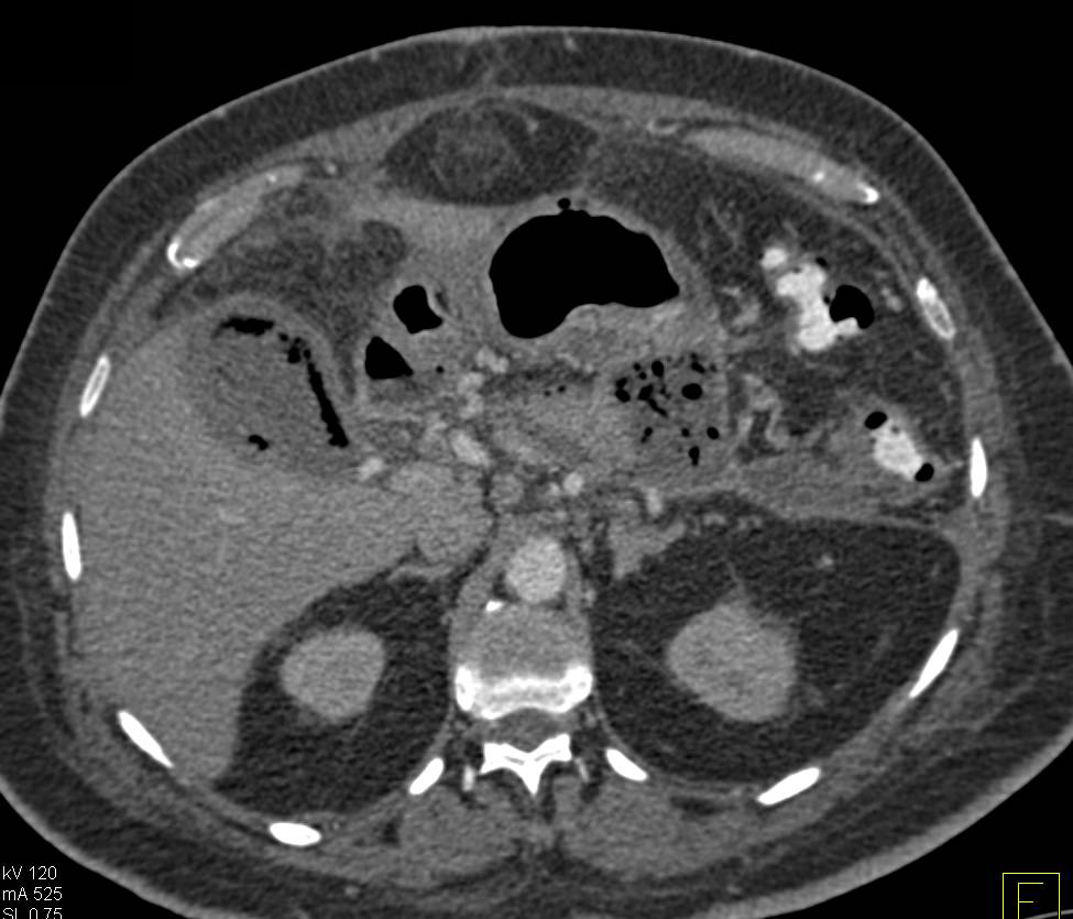 Pancreatic Necrosis and Abscess Extend into the Gallbladder Fossa - CTisus CT Scan