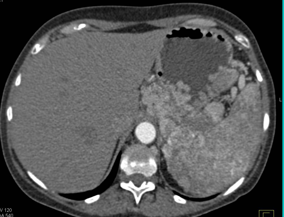 Neuroendocrine Tumor of the Pancreas with Vascular Invasion - CTisus CT Scan