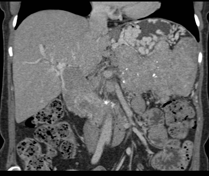 Pancreatic Neuroendocrine Tumor Invades the Portal Vein with Extensive Collaterals - CTisus CT Scan