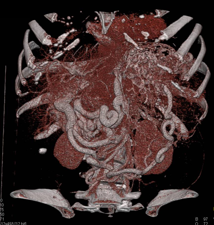 Neuroendocrine Tumor of the Pancreas with Liver Metastases and Incredible Collaterals due to Portal Vein Thrombosis and Clots - CTisus CT Scan