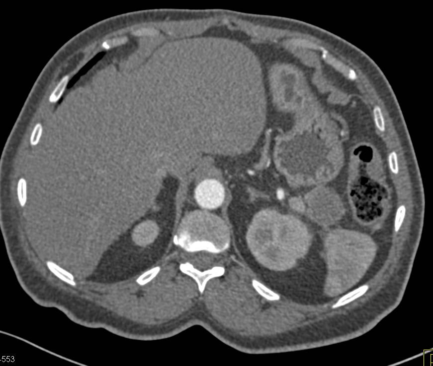 MCN or Mucinous Cystic Neoplasm of the Pancreas - CTisus CT Scan