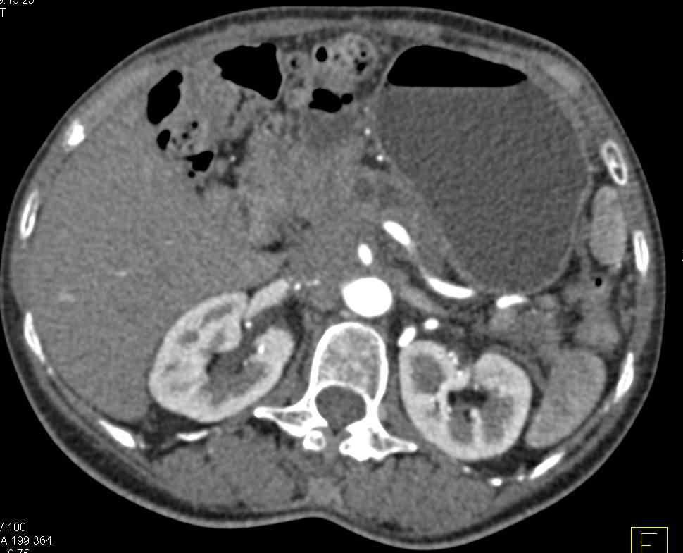 Pancreatic Cancer Encases the SMA/Celiac Axis - CTisus CT Scan