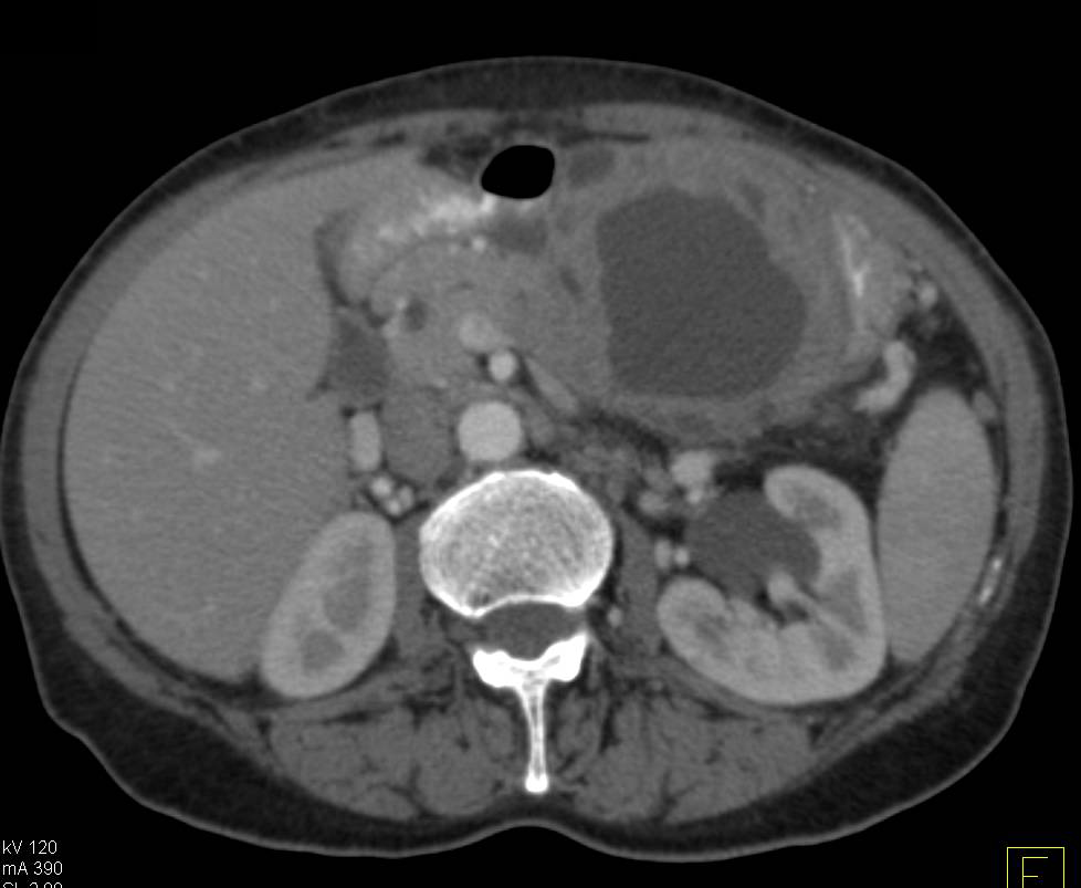 Cystic Pancreatic Mass Pushes on Stomach and was a Pseudocyst - CTisus CT Scan