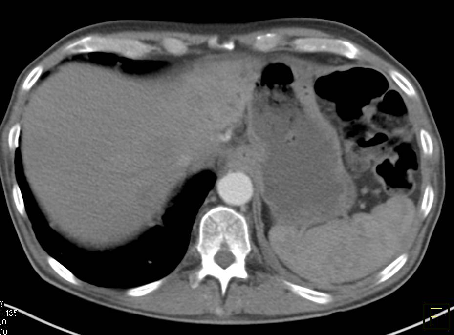 Pancreatic Adenocarcinoma with Liver Metastases - CTisus CT Scan