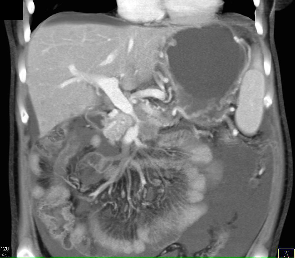 Pancreatic Cancer with Encased PV/SMV Junction and Carcinomatosis - CTisus CT Scan