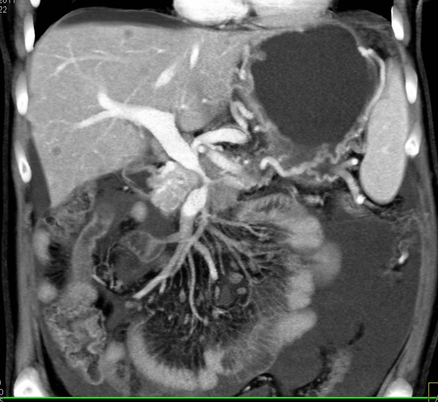 Pancreatic Cancer with Encased PV/SMV/SV with Carcinomatosis - CTisus CT Scan