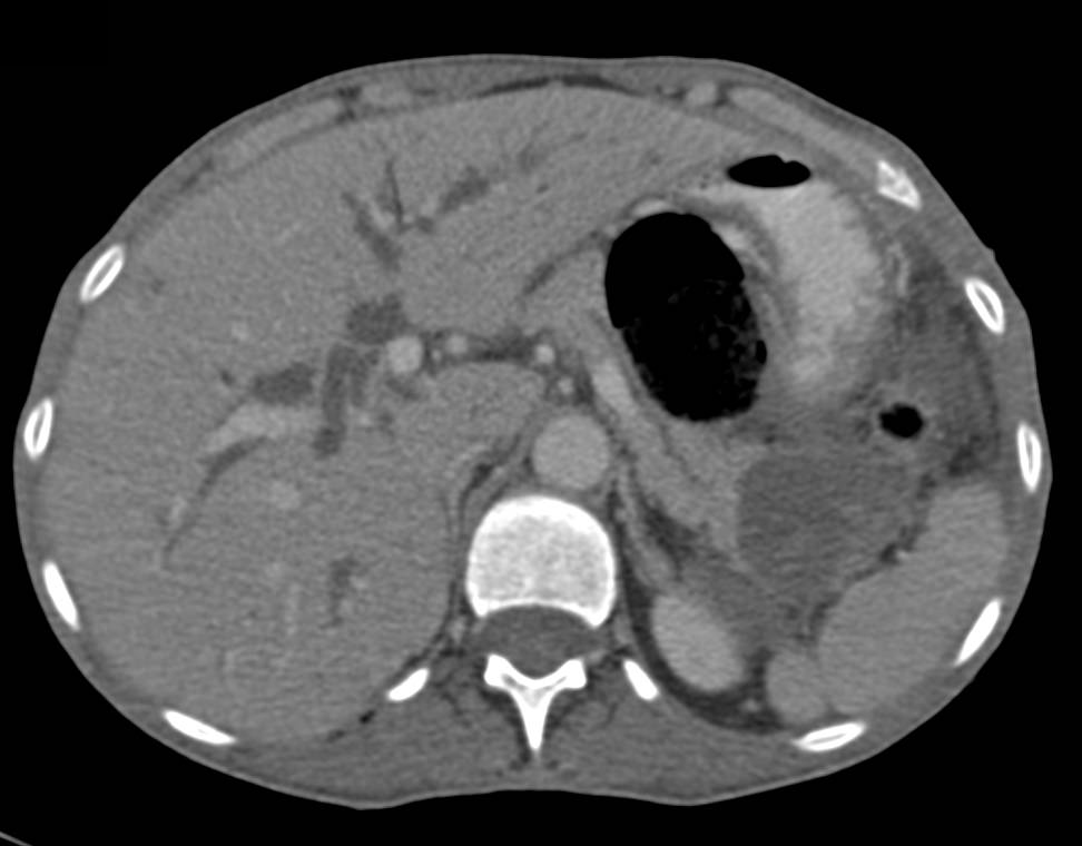 Pancreatic Cancer with Carcinomatosis - CTisus CT Scan