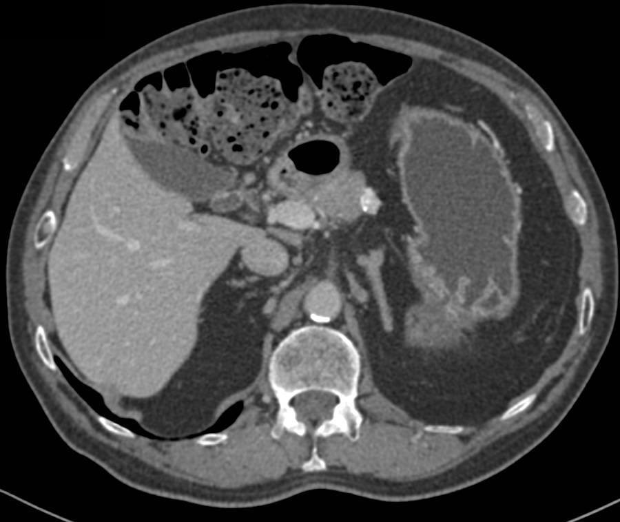 Surgical Margin from Distal Pancreatectomy Simulates a Local Recurrence - CTisus CT Scan