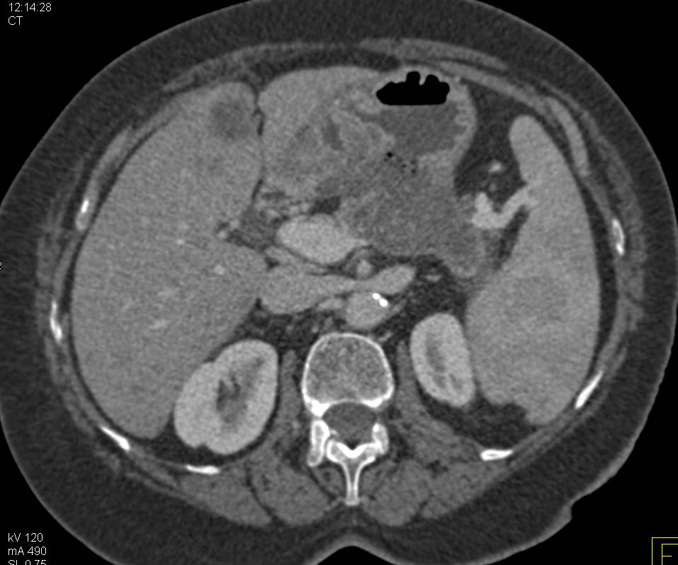 Pancreatic Adenocarcinoma Involves Stomach and Liver - CTisus CT Scan