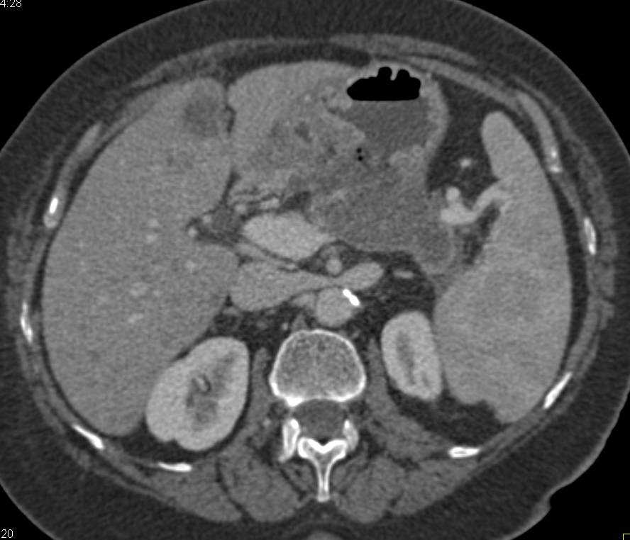 Pancreatic Cancer with Local Spread and Liver Metastases - CTisus CT Scan