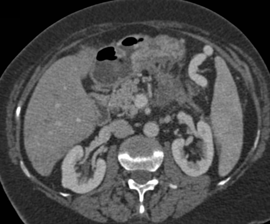 Pancreatic Cancer with Local Spread and Liver Metastases