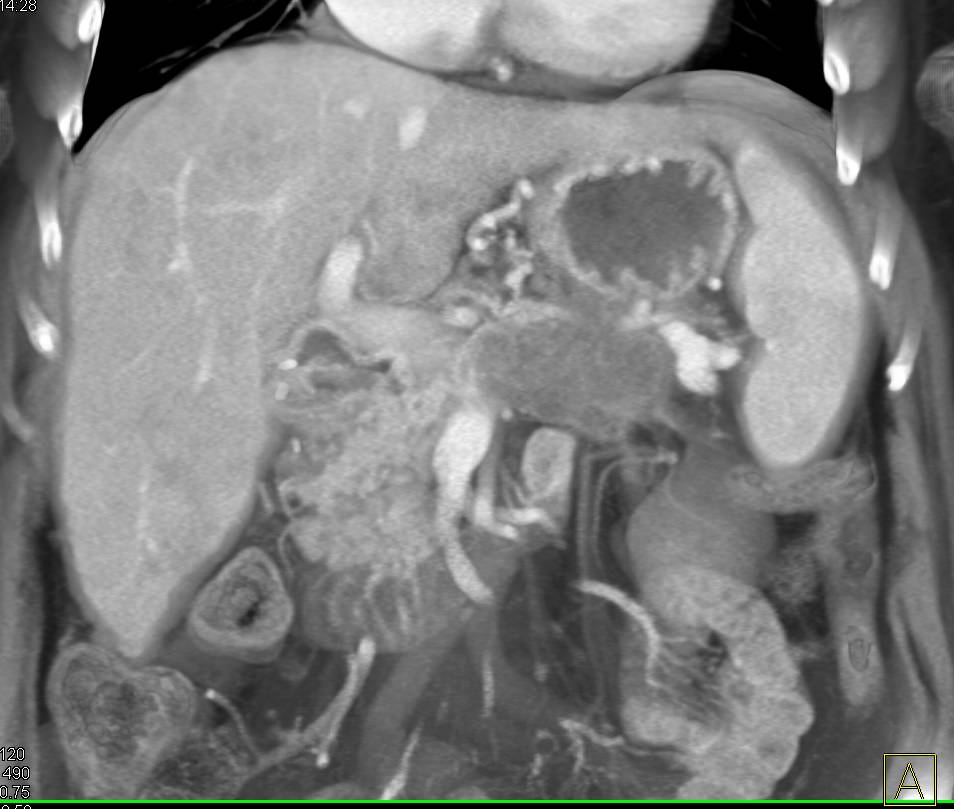 Pancreatic Cancer with Local Spread and Liver Metastases