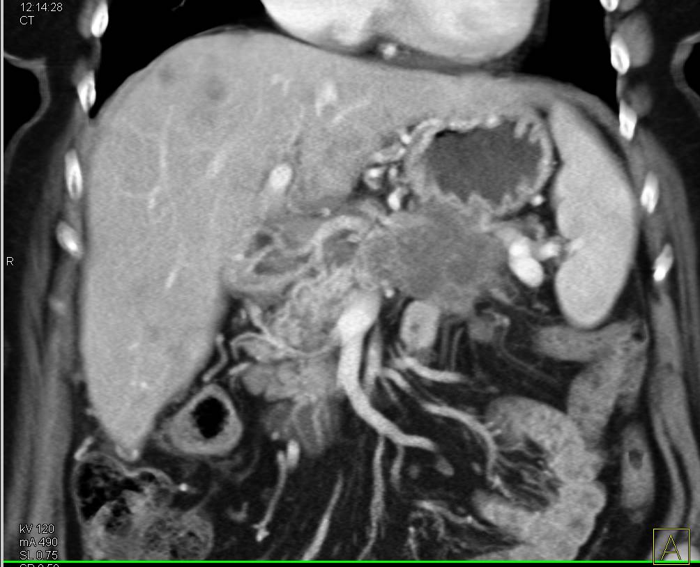 Pancreatic cancer spreading to liver