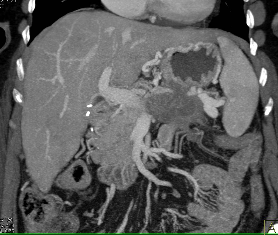 Pancreatic Cancer with Local Spread and Liver Metastases