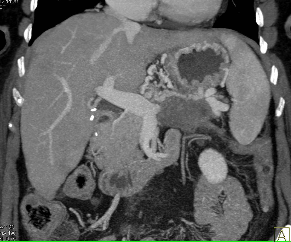 Pancreatic Cancer with Local Spread and Liver Metastases