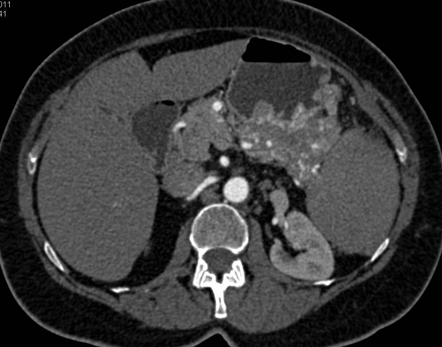 Neuroendocrine Tumor of the Tail of the Pancreas with Vascular Invasion - CTisus CT Scan