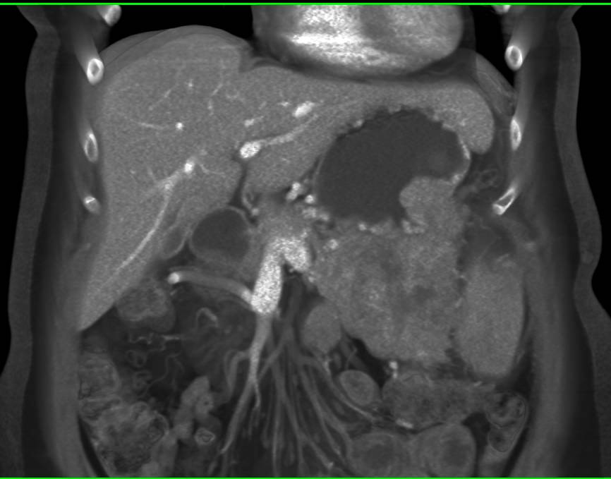 Neuroendocrine Tumor of the Tail of the Pancreas - CTisus CT Scan