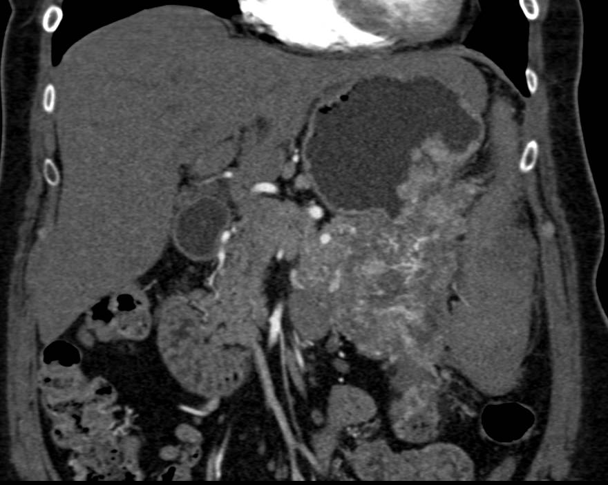 Neuroendocrine Tumor of the Tail of the Pancreas - CTisus CT Scan