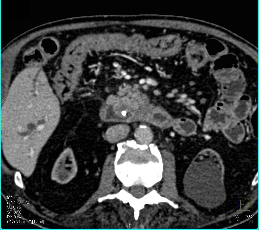 Subtle Ampullary Carcinoma - CTisus CT Scan