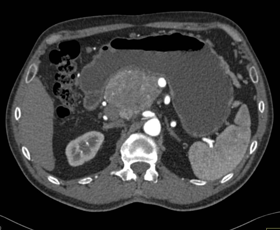 Neuroendocrine Tumor of the Pancreas Involves the Head of the Pancreas - CTisus CT Scan