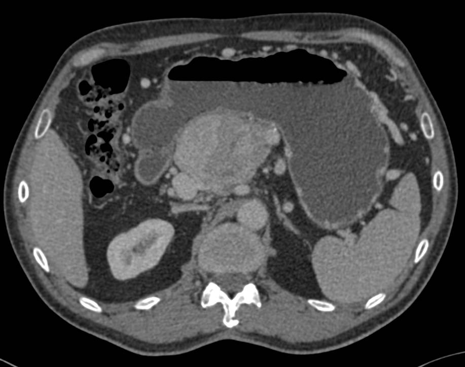 Neuroendocrine Tumor in the Head of the Pancreas - CTisus CT Scan