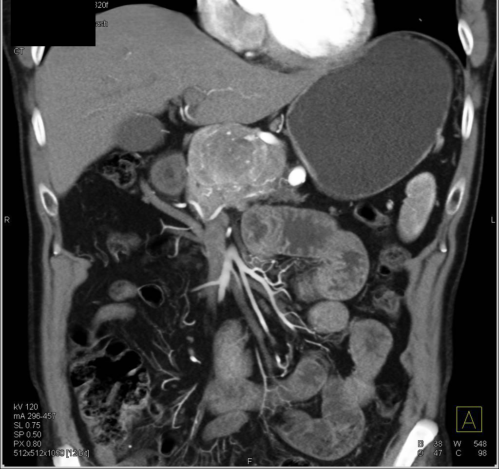 Neuroendocrine Tumor in the Head of the Pancreas - CTisus CT Scan