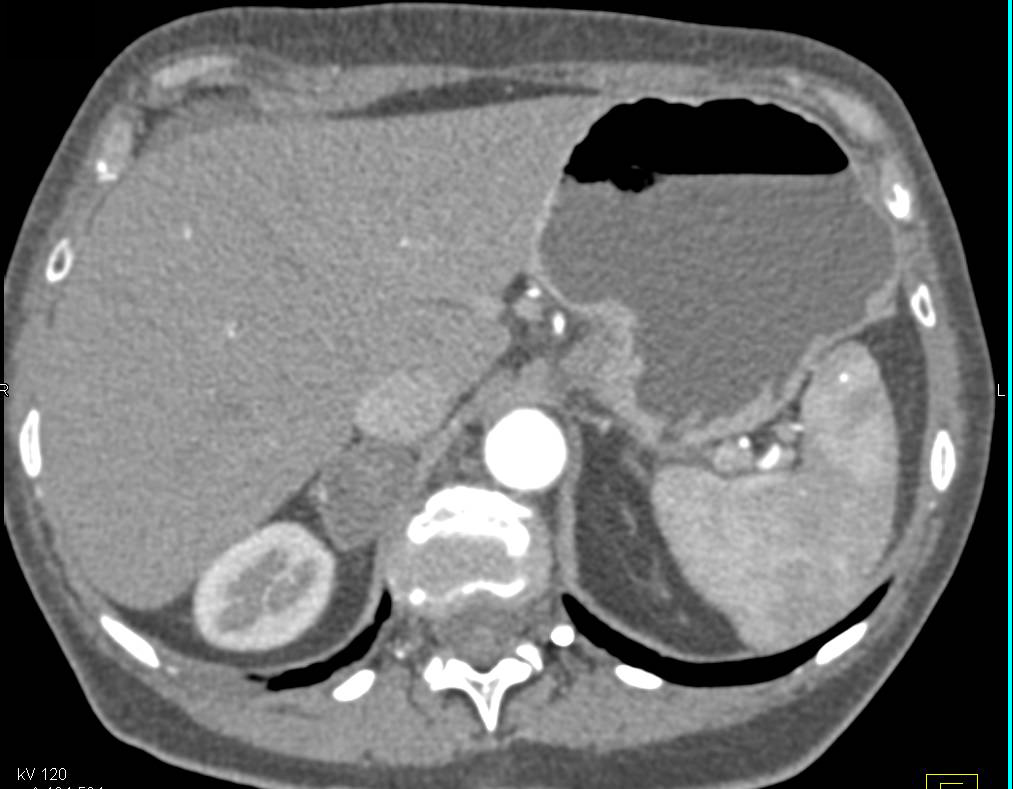 Carcinoma of the Tail of the Pancreas with Adrenal Adenoma - CTisus CT Scan