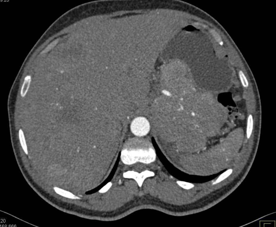 Neuroendocrine Tumor Tail of Pancreas with Liver Metastases - CTisus CT Scan