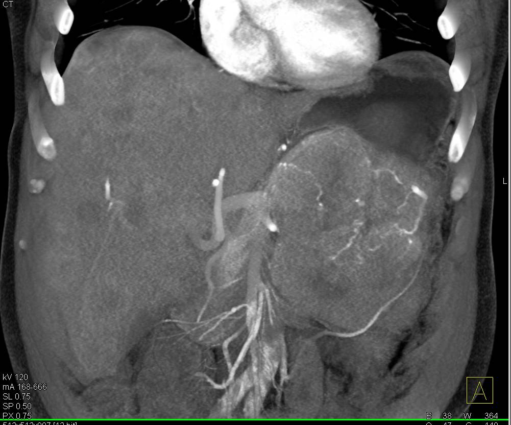 Neuroendocrine Tumor of the Pancreas Involves the Stomach and Liver - CTisus CT Scan