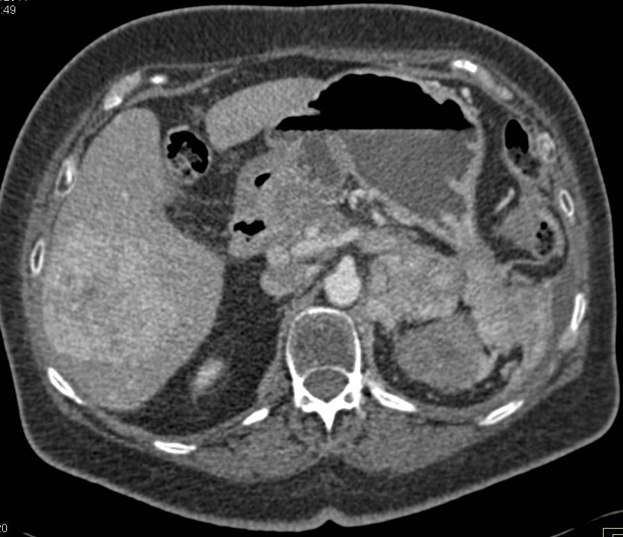 Metastatic Neuroendocrine Tumor Tail of Pancreas - CTisus CT Scan