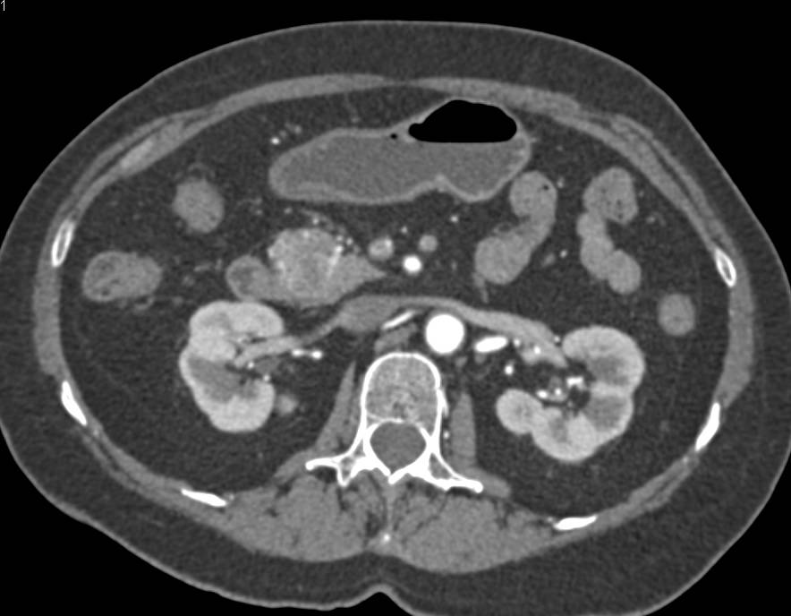 Serous Cystadenoma in Head of the Pancreas Simulates a Neuroendocrine Tumor - CTisus CT Scan