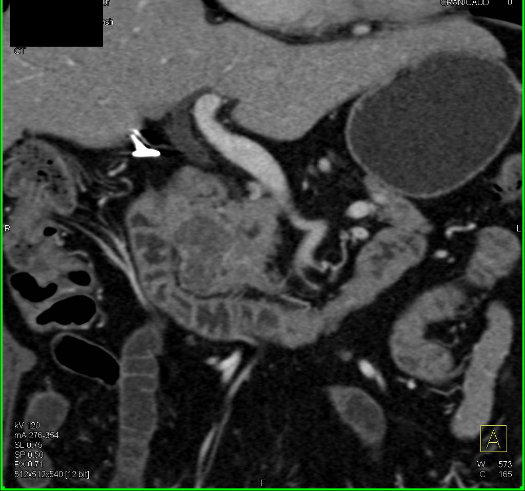 Serous Cystadenoma in Head of the Pancreas - CTisus CT Scan